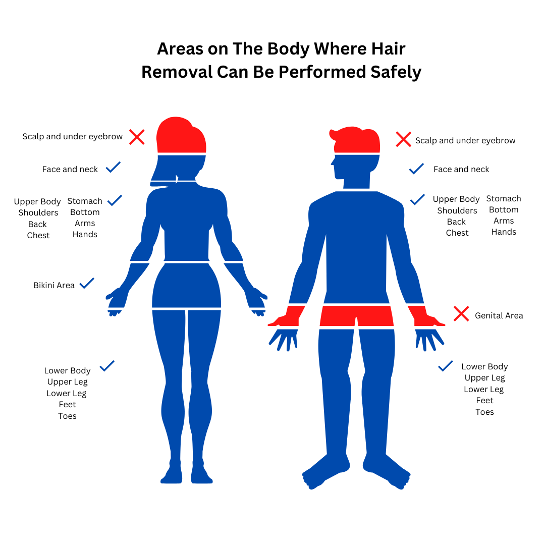 Everything You Can Laser Off 101 Delta Explains Laser Hair Removal